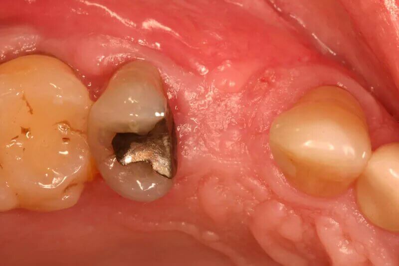 case-1-dental-implant-before