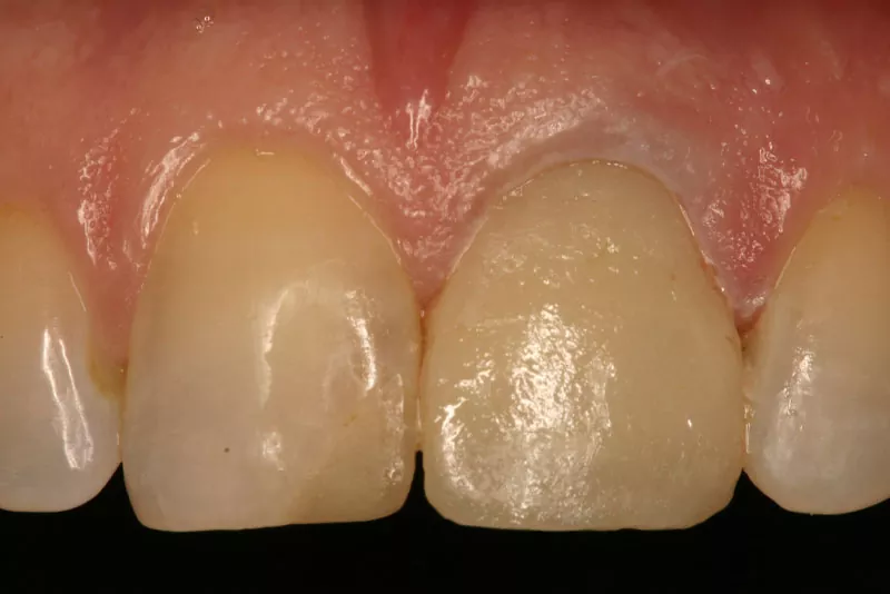 case-2-dental-implant-after