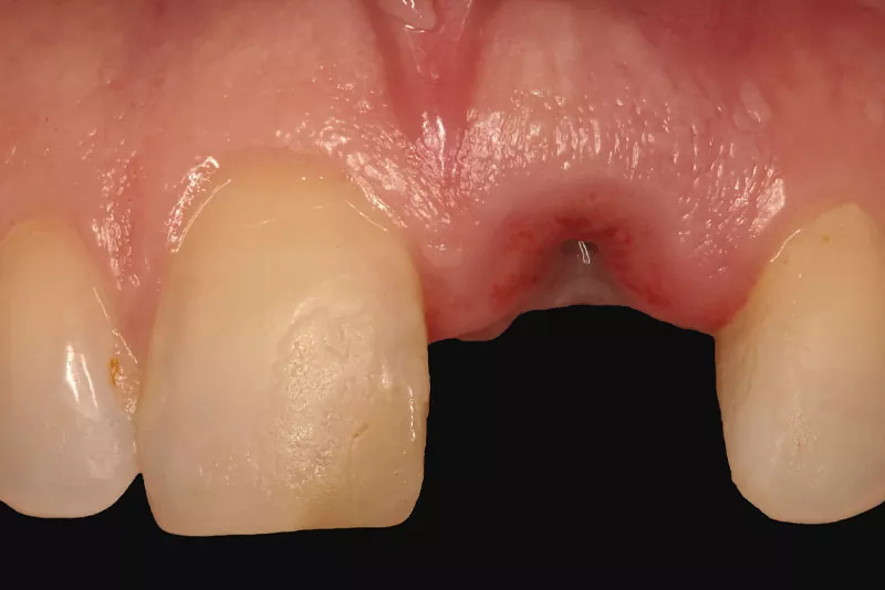 case-2-dental-implant-before