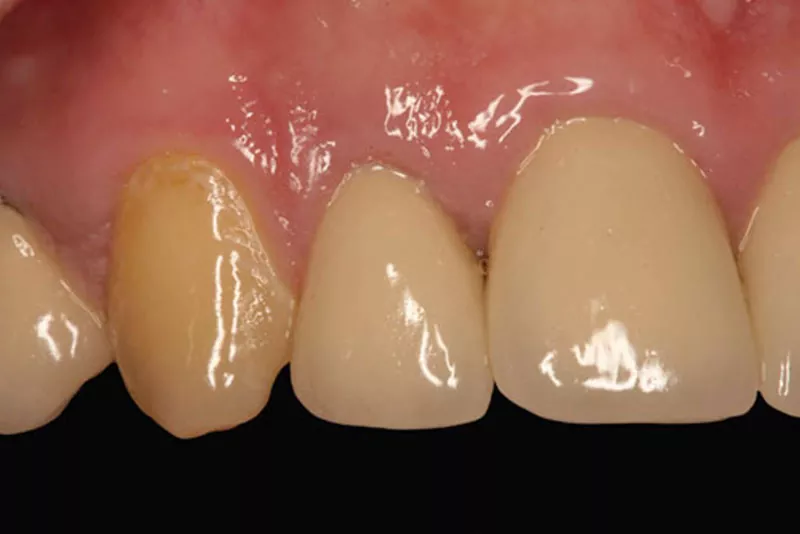 case-3-dental-implant-after