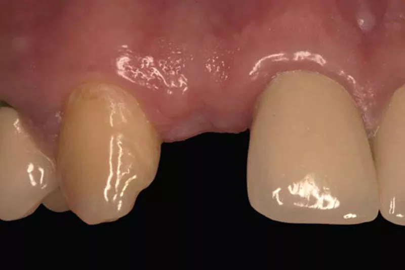 case-3-dental-implant-before