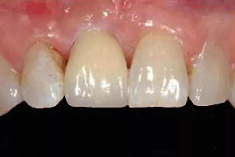 case-4-dental-implant-after