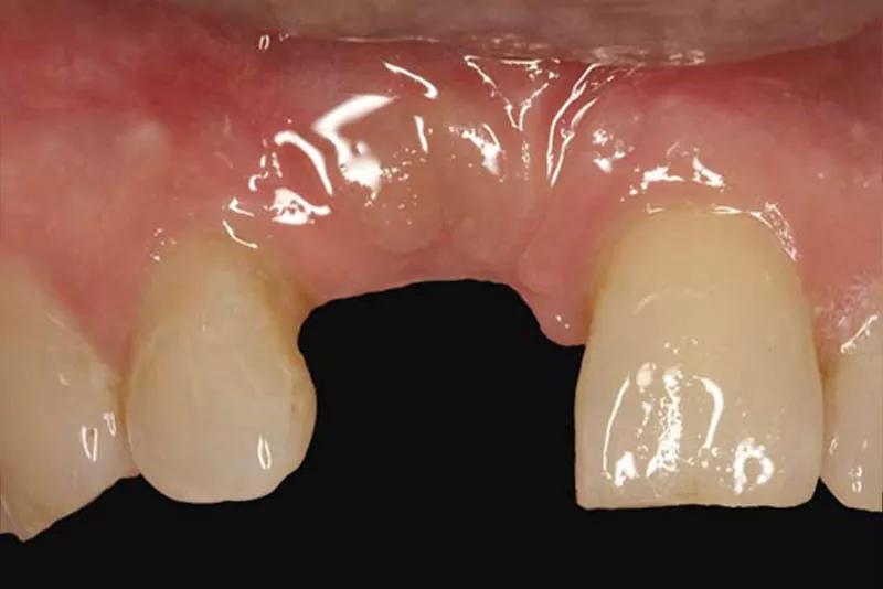 case-4-dental-implant-before
