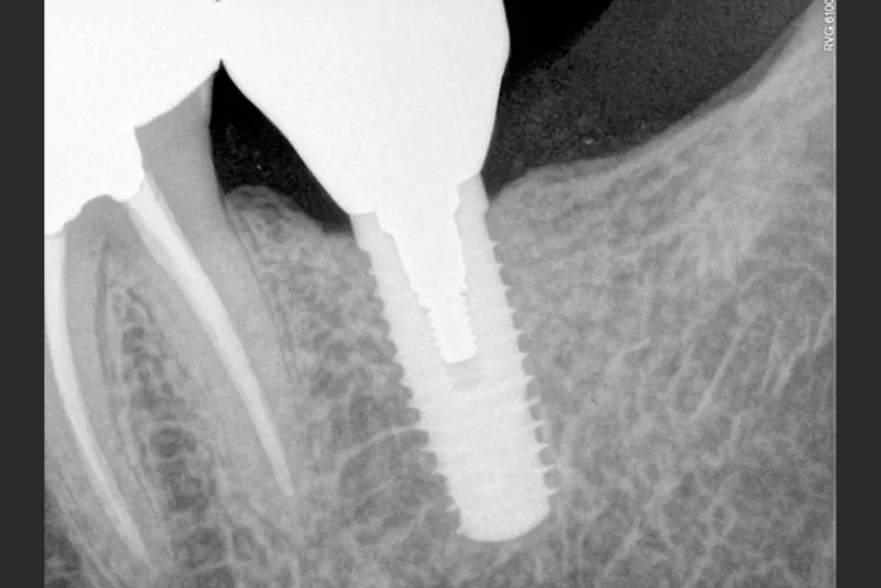 case-6-dental-implant-after