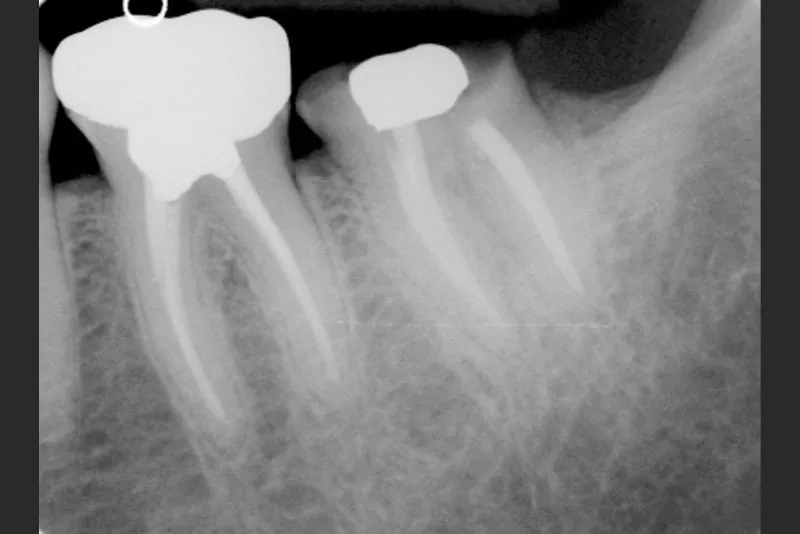 case-6-dental-implant-before
