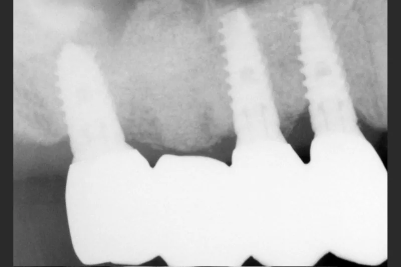 case-7-dental-implant-after