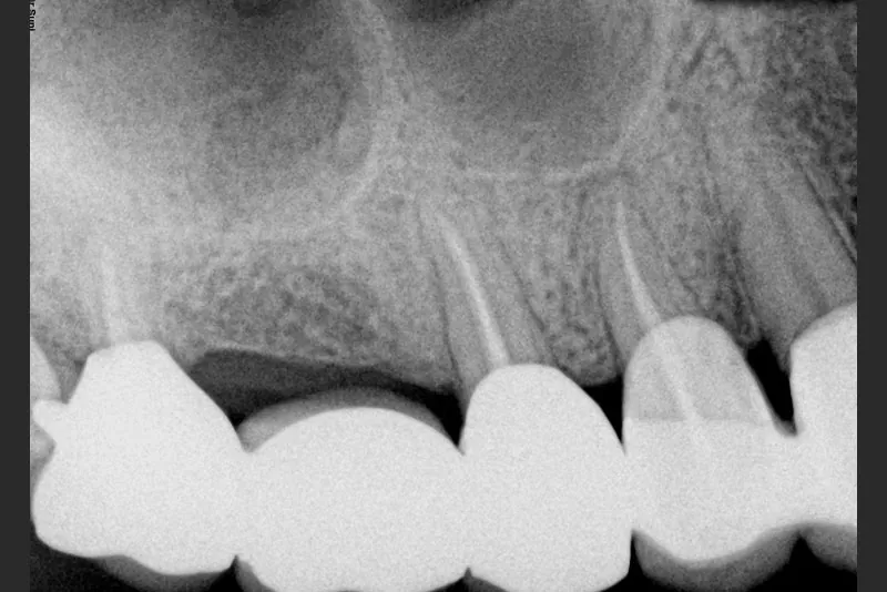 case-7-dental-implant-before