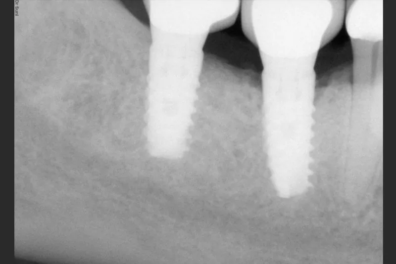 case-8-dental-implant-after