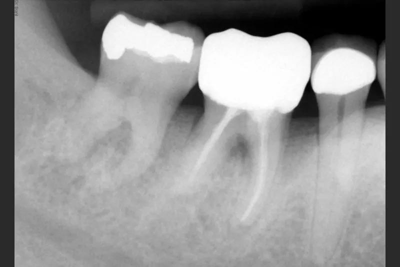 case-8-dental-implant-before