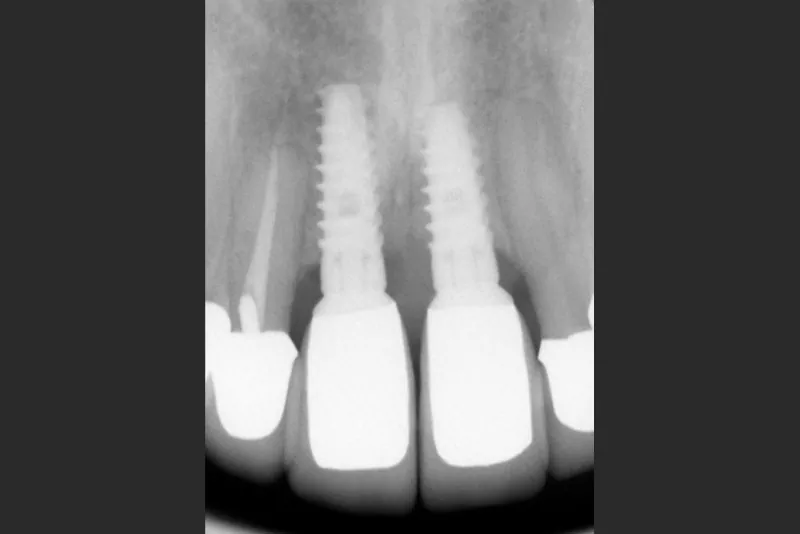case-9-dental-implant-after