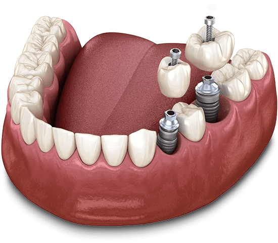 dental-implant-graphic