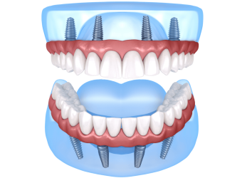 Teeth-img